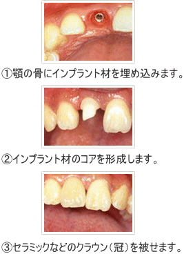 インプラント